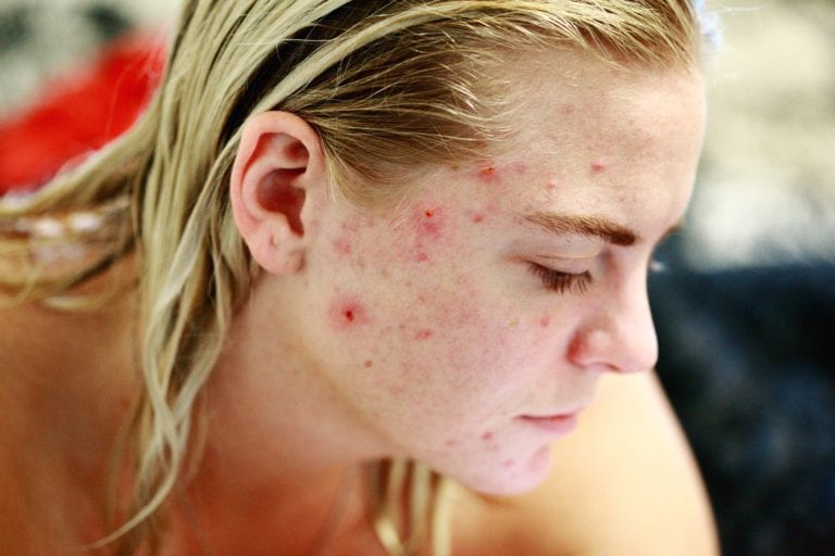 What’s The Difference Between Eczema And Cystic Acne, And What Are The
